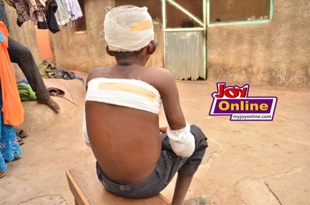 11-year-old boy doused with petrol, set on fire