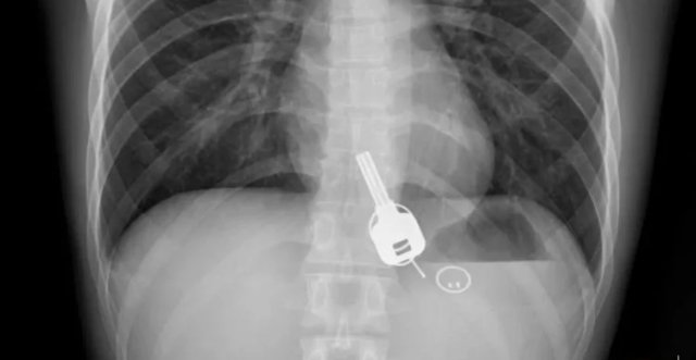 7646835951755_7193819200620 man swallow key