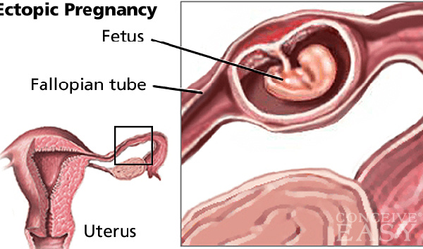 86511007 abortion