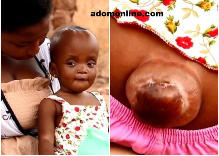The 11-month old baby has abnormal large head and growth at the back. The 11-month old baby has abnormal large head and growth at the back.