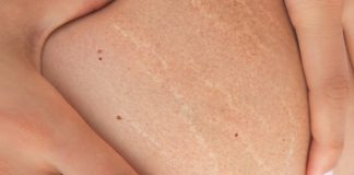 stretch marks