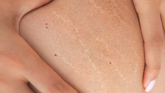stretch marks stretch marks