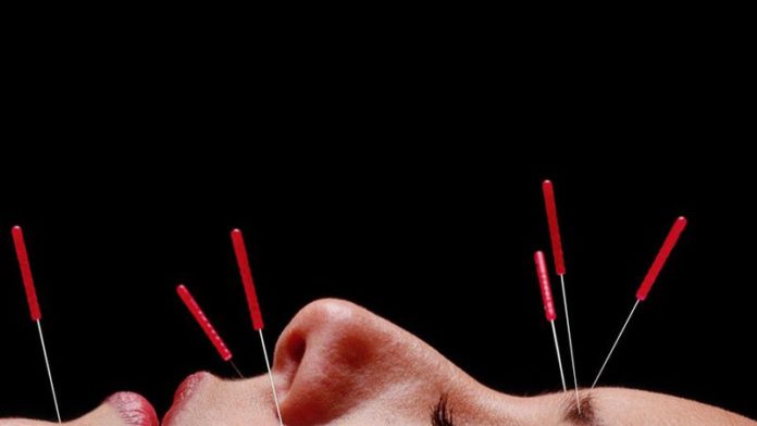 acupuncture acupuncture