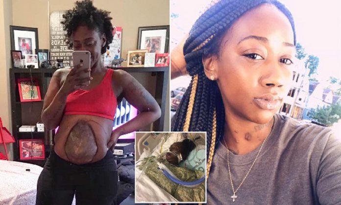 Takieyah Reaves now lives with her intestines hanging out of her abdomen Takieyah Reaves now lives with her intestines hanging out of her abdomen