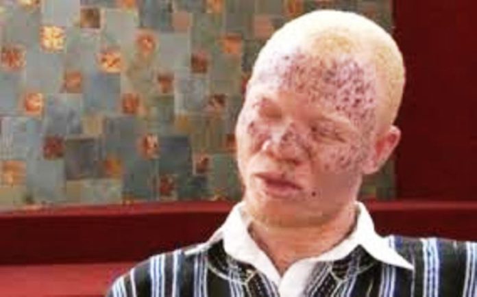 Albino
