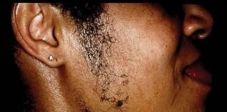 File photo: Woman with facial hair