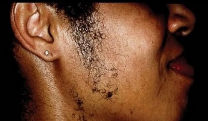 File photo: Woman with facial hair File photo: Woman with facial hair