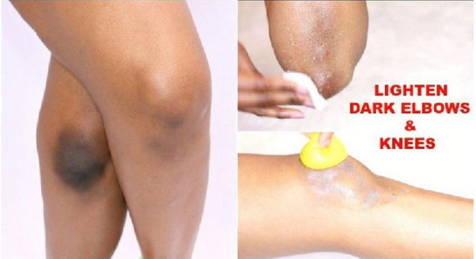 Lemon, baking soda, coconut oil can be used to lighten your dark elbows and knuckles Lemon, baking soda, coconut oil can be used to lighten your dark elbows and knuckles
