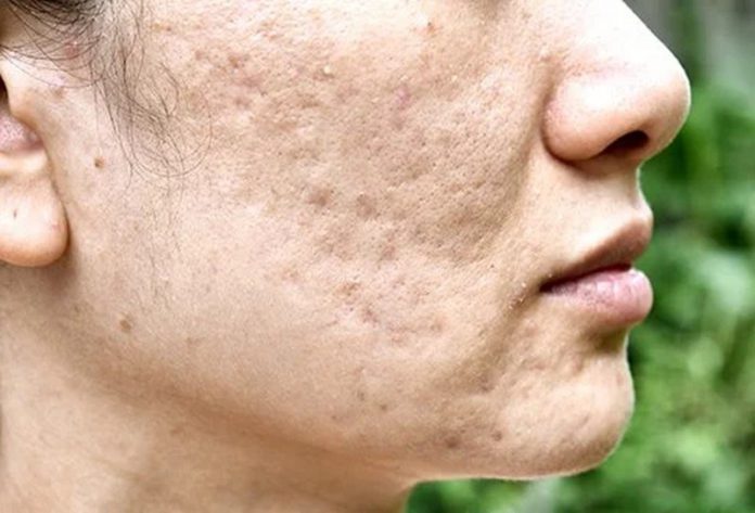 cystic-acne-1 (Copy) acne