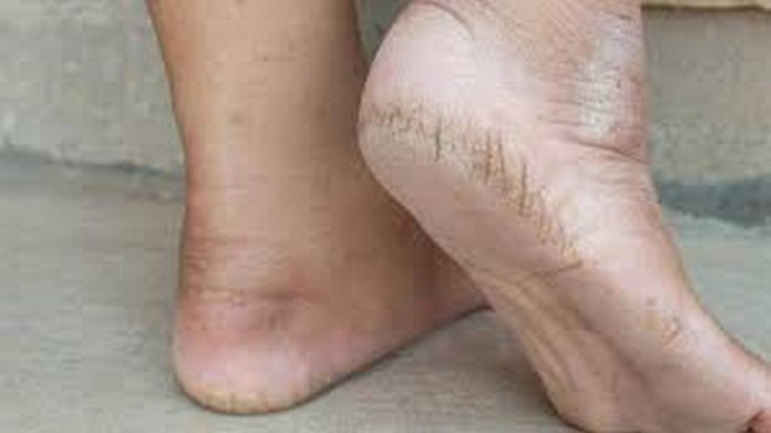 downlocracked heelsad (Copy) cracked heels