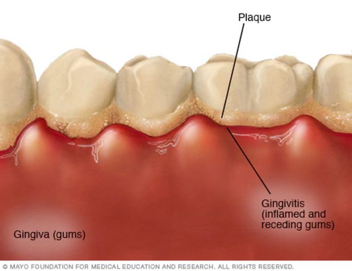 gingivitis teeth gingivitis teeth
