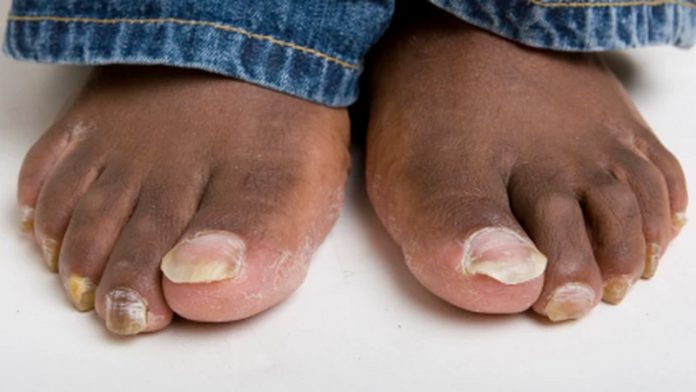 4 home remedies to treating toenail fungus(Copy) 4 home remedies to treating toenail fungus