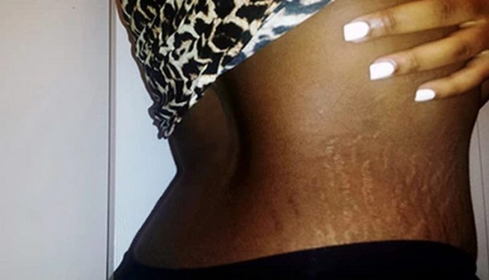 stretch marks stretch marks