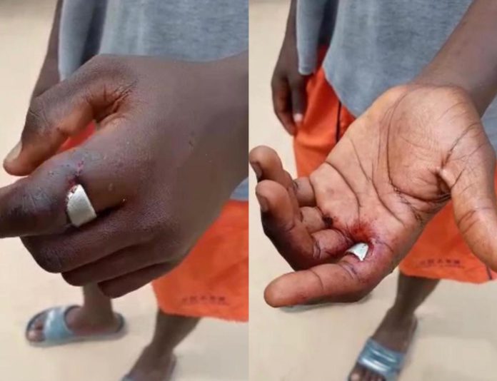 Teenage boy losing finger for wearing friend’s ‘sakawa’ ring