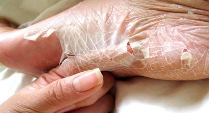 Peeling skin (Copy) Peeling skin