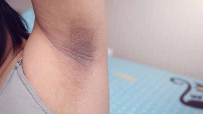 Dark underarm Dark underarm