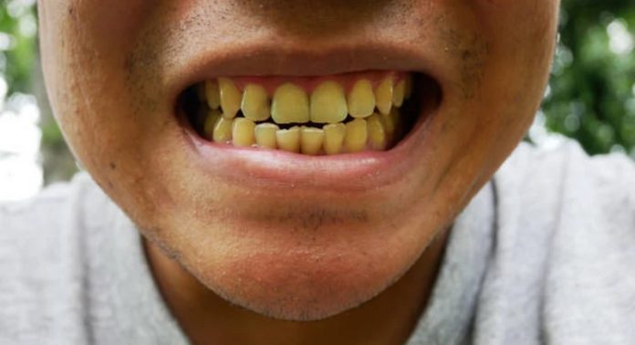 5 effective ways to get rid of yellow teeth 5 effective ways to get rid of yellow teeth