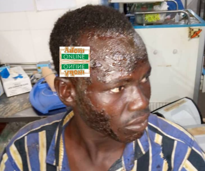 eam burns man's face at Gomoa Budumburam