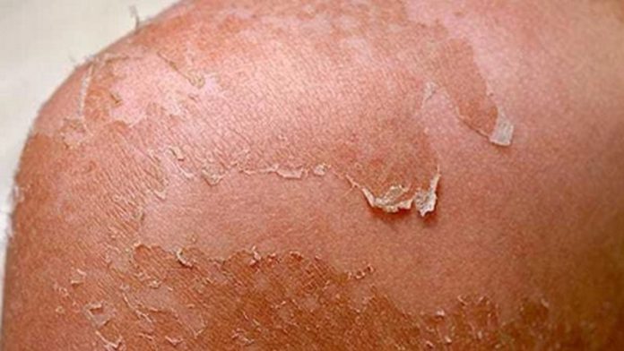Peeling skin(Copy)