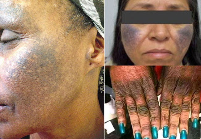 Skin bleaching effect