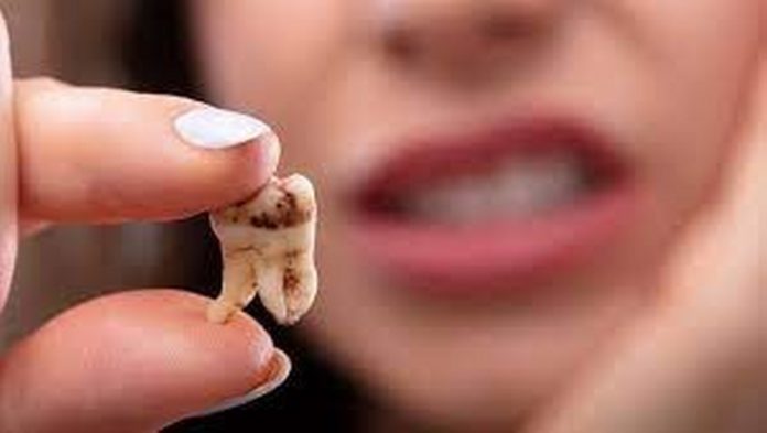 tooth decay