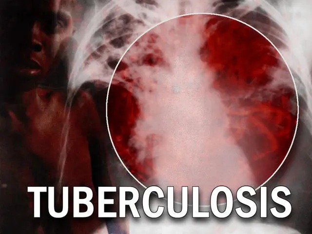 tuberculosis