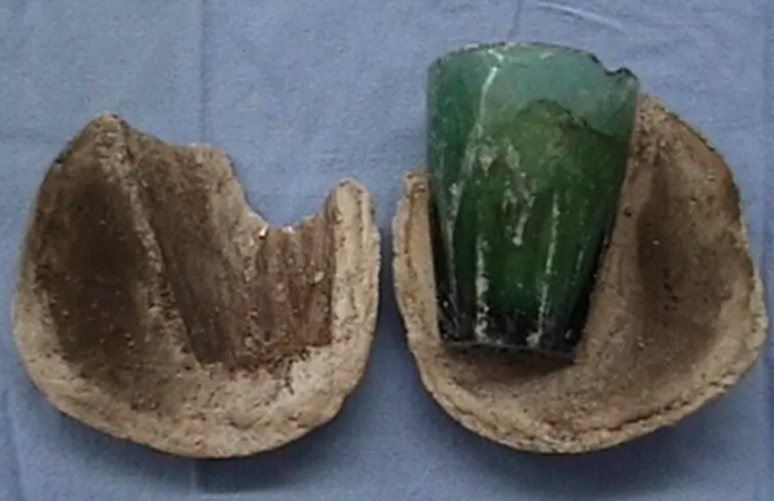 Glass tumbler found in woman’s bladder 4 years after she used it as s3x toy