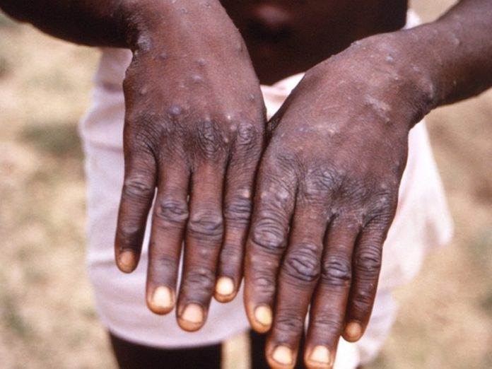 Monkeypox-virus-565x424 (Copy)
