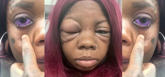 Mother-of-five going blind after tattooing her eyeball purple