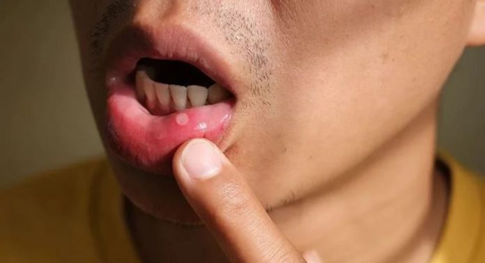 Mouth ulcer Mouth ulcer