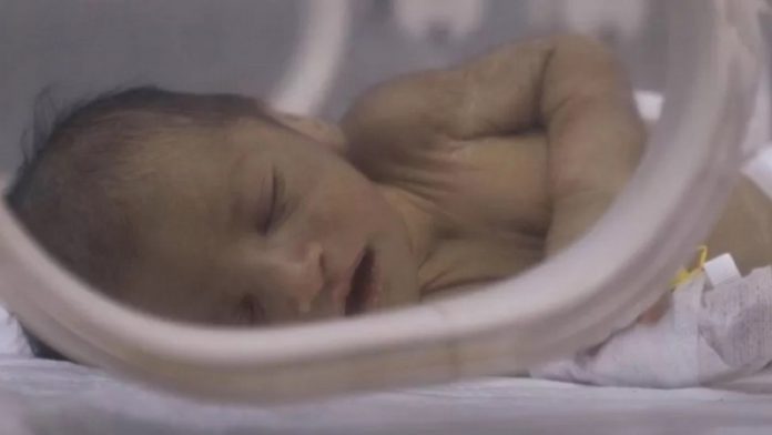 Adnan's condition has improved significantly since he was admitted to hospital with dehydration and jaundice Adnan's condition has improved significantly since he was admitted to hospital with dehydration and jaundice