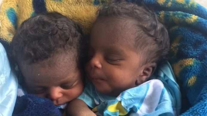 Conjoined-twin-girls-Anick-and-Destin-survived-their-birth-before-being-separated-754x424