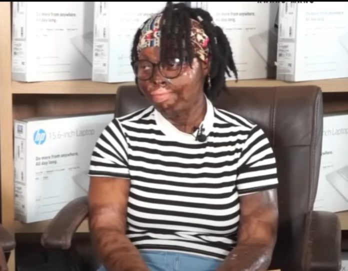 Acid attack victim