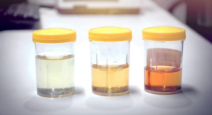 Urine sample Urine sample