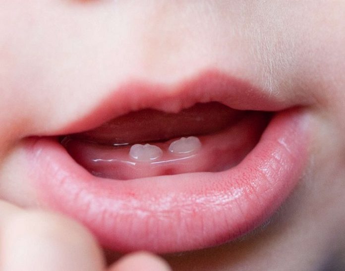 natal_teeth (Copy)