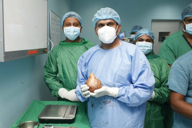 world's largest kidney stone