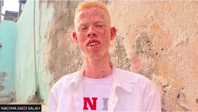 Somali-Albinos (Copy)