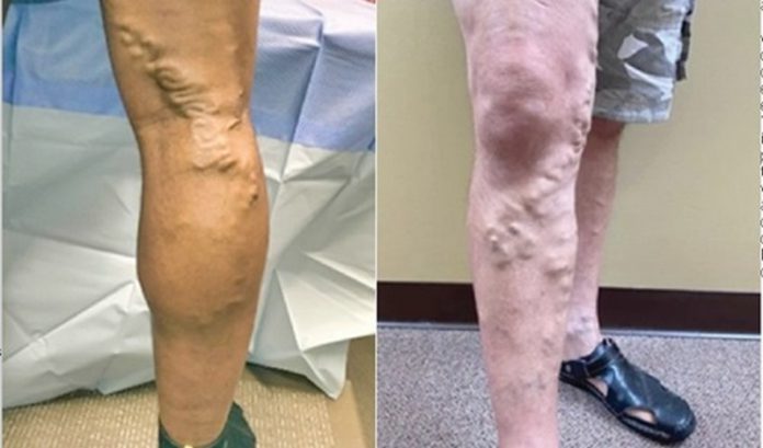 varicose_veins (Copy)