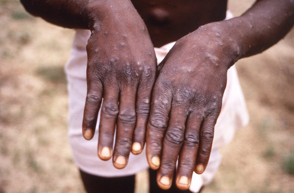 As deadly mpox virus outbreak emerges, a lack of diagnostic testing capacity is putting children at risk
