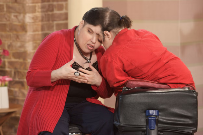 World's oldest conjoined twins die at 62