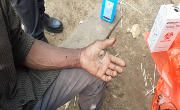 Uganda: Fighting Anthrax through mindset change on health seeking behaviour