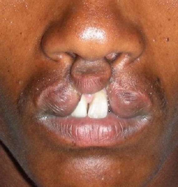 cleft (Copy)