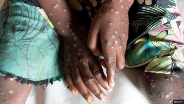Monkeypox Monkeypox
