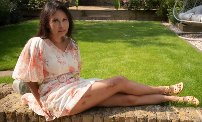 Elaine Foo/Supplied Elaine has suffered excruciating pain after her leg-lengthening surgery Elaine Foo/Supplied Elaine has suffered excruciating pain after her leg-lengthening surgery