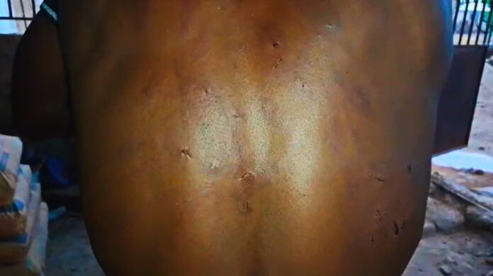 Alfred Agandaah shows injuries on his back which he says were inflicted by his abductors